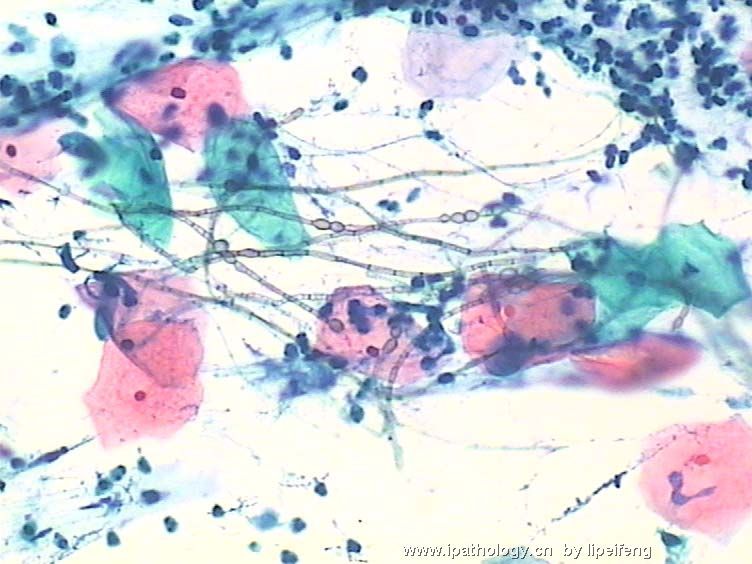 宫颈液基细胞欣赏图3