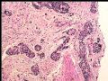 膀胱肿瘤活检－膀胱浸润性尿路上皮癌，巢状亚型图1