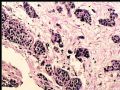 膀胱肿瘤活检－膀胱浸润性尿路上皮癌，巢状亚型图2