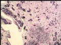 膀胱肿瘤活检－膀胱浸润性尿路上皮癌，巢状亚型图3