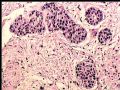膀胱肿瘤活检－膀胱浸润性尿路上皮癌，巢状亚型图4