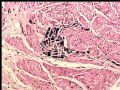 膀胱肿瘤活检－膀胱浸润性尿路上皮癌，巢状亚型图5