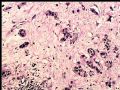 膀胱肿瘤活检－膀胱浸润性尿路上皮癌，巢状亚型图6