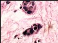 膀胱肿瘤活检－膀胱浸润性尿路上皮癌，巢状亚型图7