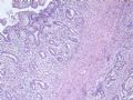 肝肿瘤－－肝内胆管多发性结石伴胆管上皮增生、恶变图1