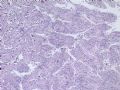 肝肿瘤－－肝内胆管多发性结石伴胆管上皮增生、恶变图2