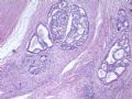 肝肿瘤－－肝内胆管多发性结石伴胆管上皮增生、恶变图3