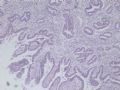 肝肿瘤－－肝内胆管多发性结石伴胆管上皮增生、恶变图4