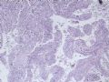 肝肿瘤－－肝内胆管多发性结石伴胆管上皮增生、恶变图5