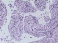 肝肿瘤－－肝内胆管多发性结石伴胆管上皮增生、恶变图6
