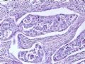 肝肿瘤－－肝内胆管多发性结石伴胆管上皮增生、恶变图7