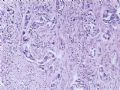 肝肿瘤－－肝内胆管多发性结石伴胆管上皮增生、恶变图9