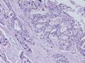肝肿瘤－－肝内胆管多发性结石伴胆管上皮增生、恶变图10