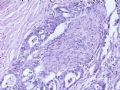 肝肿瘤－－肝内胆管多发性结石伴胆管上皮增生、恶变图11