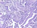 肝肿瘤－－肝内胆管多发性结石伴胆管上皮增生、恶变图12