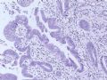 肝肿瘤－－肝内胆管多发性结石伴胆管上皮增生、恶变图13