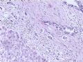 肝肿瘤－－肝内胆管多发性结石伴胆管上皮增生、恶变图14