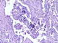 肝肿瘤－－肝内胆管多发性结石伴胆管上皮增生、恶变图15