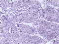 肝肿瘤－－肝内胆管多发性结石伴胆管上皮增生、恶变图17