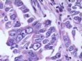 肝肿瘤－－肝内胆管多发性结石伴胆管上皮增生、恶变图18
