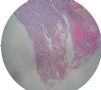 F19Y卵巢交界性粘囊伴附壁结节图5