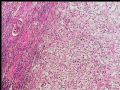 左肾上极肿瘤－透明细胞癌图1
