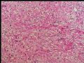 左肾上极肿瘤－透明细胞癌图6