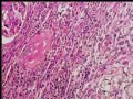 左肾上极肿瘤－透明细胞癌图7