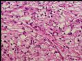 左肾上极肿瘤－透明细胞癌图8