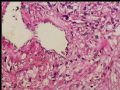 左肾上极肿瘤－透明细胞癌图9