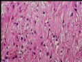 左肾上极肿瘤－透明细胞癌图10