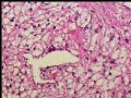 左肾上极肿瘤－透明细胞癌图12