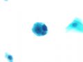宫颈液基细胞病例分析-(7)图1