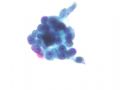 宫颈液基细胞病例分析-(7)图3
