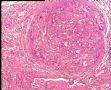 右乳肿块－ 分泌性癌图3