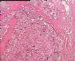 右乳肿块－ 分泌性癌图5