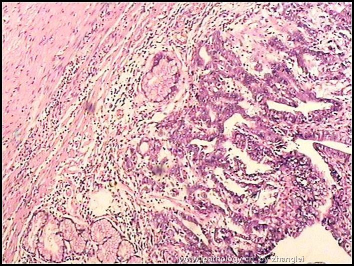 胃窦部溃疡- 粘膜内癌图1