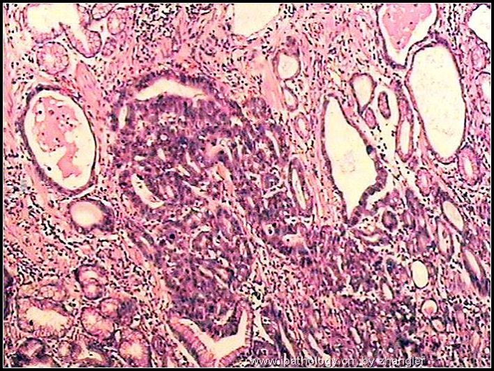 胃窦部溃疡- 粘膜内癌图2