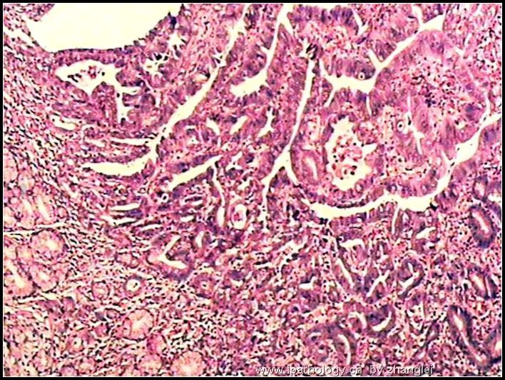 胃窦部溃疡- 粘膜内癌图3