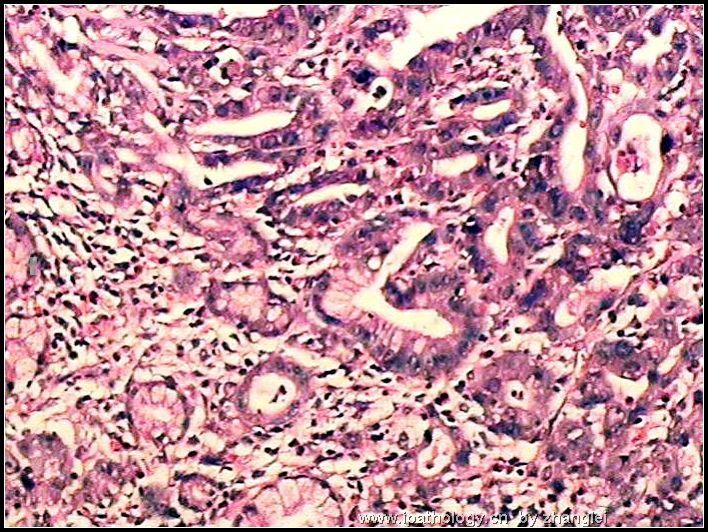 胃窦部溃疡- 粘膜内癌图6
