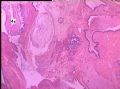 未成熟畸胎瘤（级别？）图5