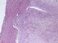 （会诊）肾脏肿瘤-恶性孤立性纤维瘤（SFT）图1