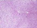 （会诊）肾脏肿瘤-恶性孤立性纤维瘤（SFT）图2