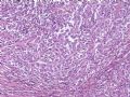 （会诊）肾脏肿瘤-恶性孤立性纤维瘤（SFT）图4