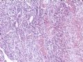 （会诊）肾脏肿瘤-恶性孤立性纤维瘤（SFT）图5