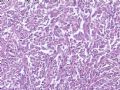 （会诊）肾脏肿瘤-恶性孤立性纤维瘤（SFT）图8