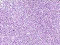 （会诊）肾脏肿瘤-恶性孤立性纤维瘤（SFT）图9