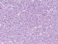 （会诊）肾脏肿瘤-恶性孤立性纤维瘤（SFT）图10