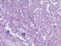 （会诊）肾脏肿瘤-恶性孤立性纤维瘤（SFT）图11