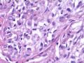 （会诊）肾脏肿瘤-恶性孤立性纤维瘤（SFT）图15